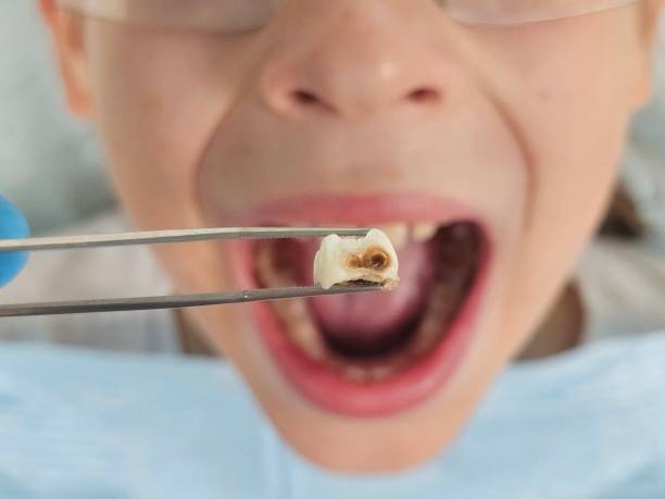 Best Emergency Wisdom Teeth Removal in Union Park, FL